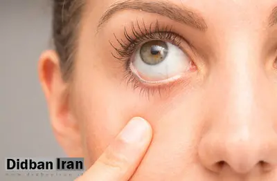 چطور با معاینه چشم میتوان فشار خون بالا، دیابت، اختلالات تیروئید، سکته مغزی آلزایمر و ام اس را تشخیص داد