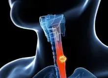 مصرف چای داغ خطر ابتلا به سرطان مری را افزایش می‌دهد