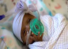  ترخیص سبک‌ترین نوزاد جهان از بیمارستانی در کالیفرنیای آمریکا 