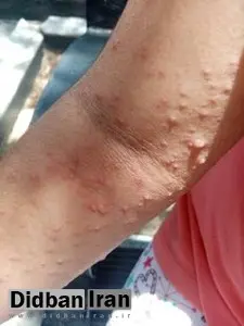 «آبله میمونی» به شمال کشور رسید!