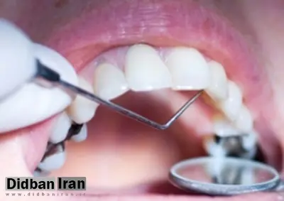 دندان های خراب منجر به افزایش ریسک زایمان زودرس می شود