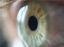 سرماخوردگی چشمی؛ بیماری شایعی که به سرعت اعضای خانواده را درگیر می‌کند