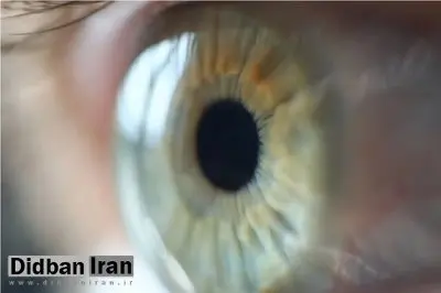سرماخوردگی چشمی؛ بیماری شایعی که به سرعت اعضای خانواده را درگیر میکند