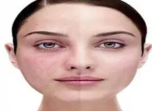 لکه های پوستی چرا و چگونه به وجود می آیند