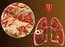 ابتلای ۶۵۰۰نفر به بیماری "سل" در ایران/ ۲۴درصد غیرایرانی‌اند