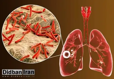 ابتلای ۶۵۰۰نفر به بیماری "سل" در ایران/ ۲۴درصد غیرایرانیاند
