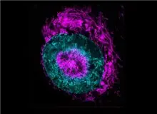 امید به درمان سرطان با کشف ابرقدرت سلول‌های سرطانی