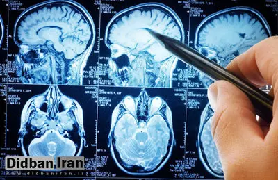 سکته مغزی و پیامدهای آن