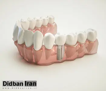 همه چیز در مورد مراحل ایمپلنت دندان