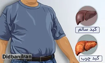 کبد چرب را با این روش به‌راحتی درمان کنید