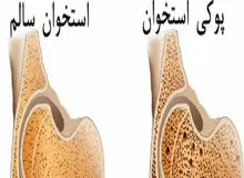 پوکی استخوان عامل ۴۲۰۰ مرگ سالانه در کشور 
