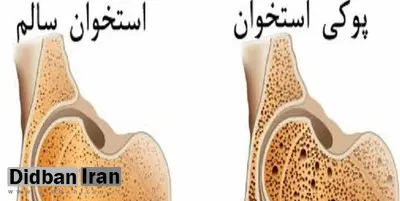 پوکی استخوان عامل ۴۲۰۰ مرگ سالانه در کشور 