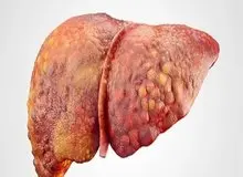 علائم و عوامل ابتلا به کبد چرب