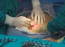 آمار ۷۰ درصدی سزارین در برخی استان‌ها 