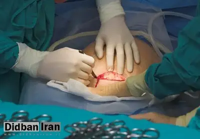 آمار ۷۰ درصدی سزارین در برخی استانها