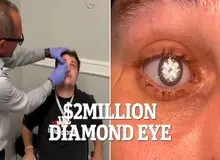 چشم مصنوعی با الماس ۲ قیراطی مردی که شبیه شرورهای جیمز باند است!