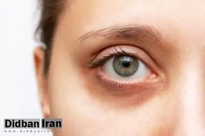 رفع سیاهی دور چشم با مصرف این ویتامینها