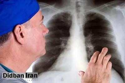 مواد شیمیایی و دخانیات عامل افزایش سرطان ریه در ایران