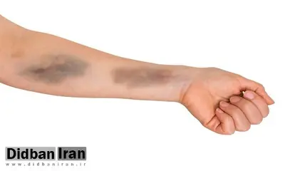 با۳  مکمل غذایی برای پیشگیری از کبودی پوست آشنا شوید/ با خواص ویتامین C، هسپریدین و روتین آشنا شوید