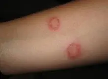 هشدار وزارت بهداشت درباره ابتلا به این بیمار؛ «کالاآزار» چیست؟
