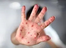 ۳ عامل بروز سرخک در ایران/شیوع بیماری تحت کنترل است