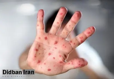 ۳ عامل بروز سرخک در ایران/شیوع بیماری تحت کنترل است