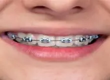 در طول ارتودنسی دندان ها چه خوراکی‌هایی نخوریم؟
