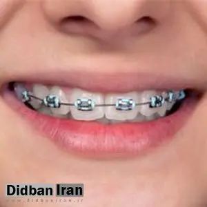 در طول ارتودنسی دندان ها چه خوراکی‌هایی نخوریم؟
