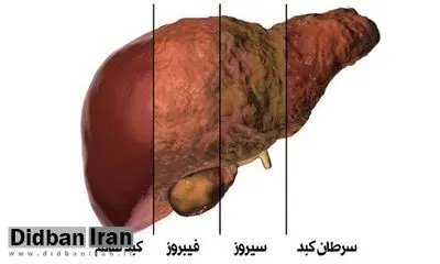 دلایل اصلی‌ بیماری کبد چرب چیست؟