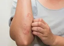 ۴ علامت پوستی که نشان می‌دهد بیماری کبد دارید