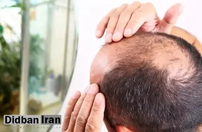 کشف تصادفی درمان طاسی؛ این قند طبیعی میتواند باعث رشد مجدد مو شود