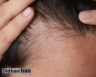 چگونه از آسیبدیدگی موها پیشگیری کنیم؟