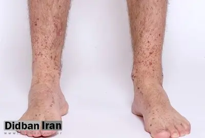 اگر ۷ علامت را دارید، به دیابت مبتلا هستید/ این نشانهها را جدی بگیرید