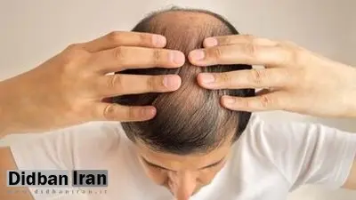 این داروی درمان ریزش مو باعث ایجاد افکار خودکشی می‌شود