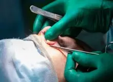 افزایش تب جراحی زیبایی بین نوجوانان ۱۴ تا ۱۸ سال در ایران