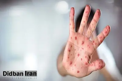 هشدار وزارت بهداشت درباره تبلیغات علیه واکسیناسیون سرخک در شبکههای اجتماعی