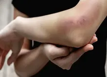 راه‌های درمان و تسکین کبودی در منزل