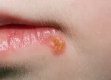 تبخال و روش‌های درمان آن