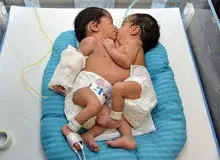 جداسازی خواهران دو قلو در بیمارستان نمازی شیراز امروز انجام می‌شود