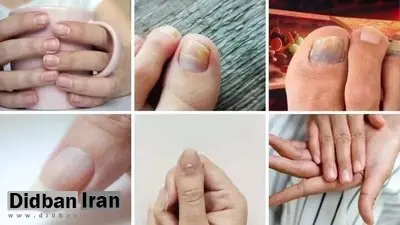۷ علامت هشداردهنده کلسترول بالا در ناخن