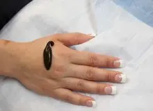 متخصصان طب سنتی: زالو درمانی هم خوب است،هم قانونی است هم پیروی از طب ابوعلی سینا/ بیماران صدمه دیده: هم هزینه فراوان دادیم، هم بیماری تشدید شد