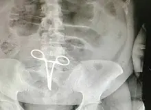 عذرخواهی رییس بیمارستان اردستان به خاطر پنسی که در شکم بیمار جا ماند / عکس