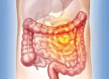 کاهش سن ابتلا به سرطان رورده بزرگ درایران