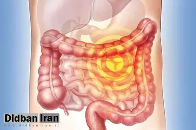 کاهش سن ابتلا به سرطان رورده بزرگ درایران