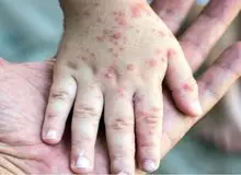 شیوع سرخک در دزفول