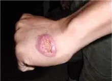 طغیان بیماری سالک در ایران/۸۰۰۰ ابتلا به سالک در یکسال گذشته 