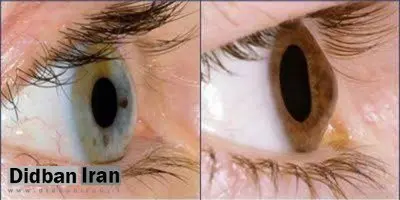 آیا استفاده مداوم از موبایل و لپ‌تاپ باعث قوز قرنیه می‌شود؟