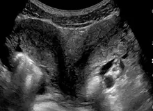 زن آمریکایی در هر دو رحم خود باردار شد