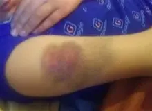 تنبیه دانش‌آموز پایه سوم ابتدایی یکی از روستاهای ‌استان قزوین+عکس 