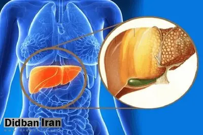 روش های خانگی برای درمان فوری کبد چرب